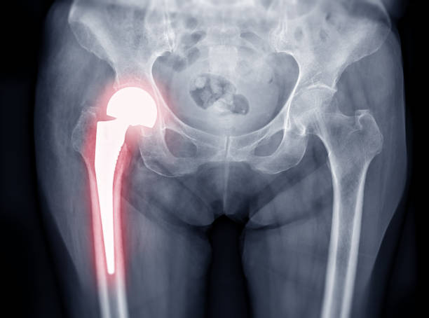 best-hip-replacement-surgeon-in-andheri